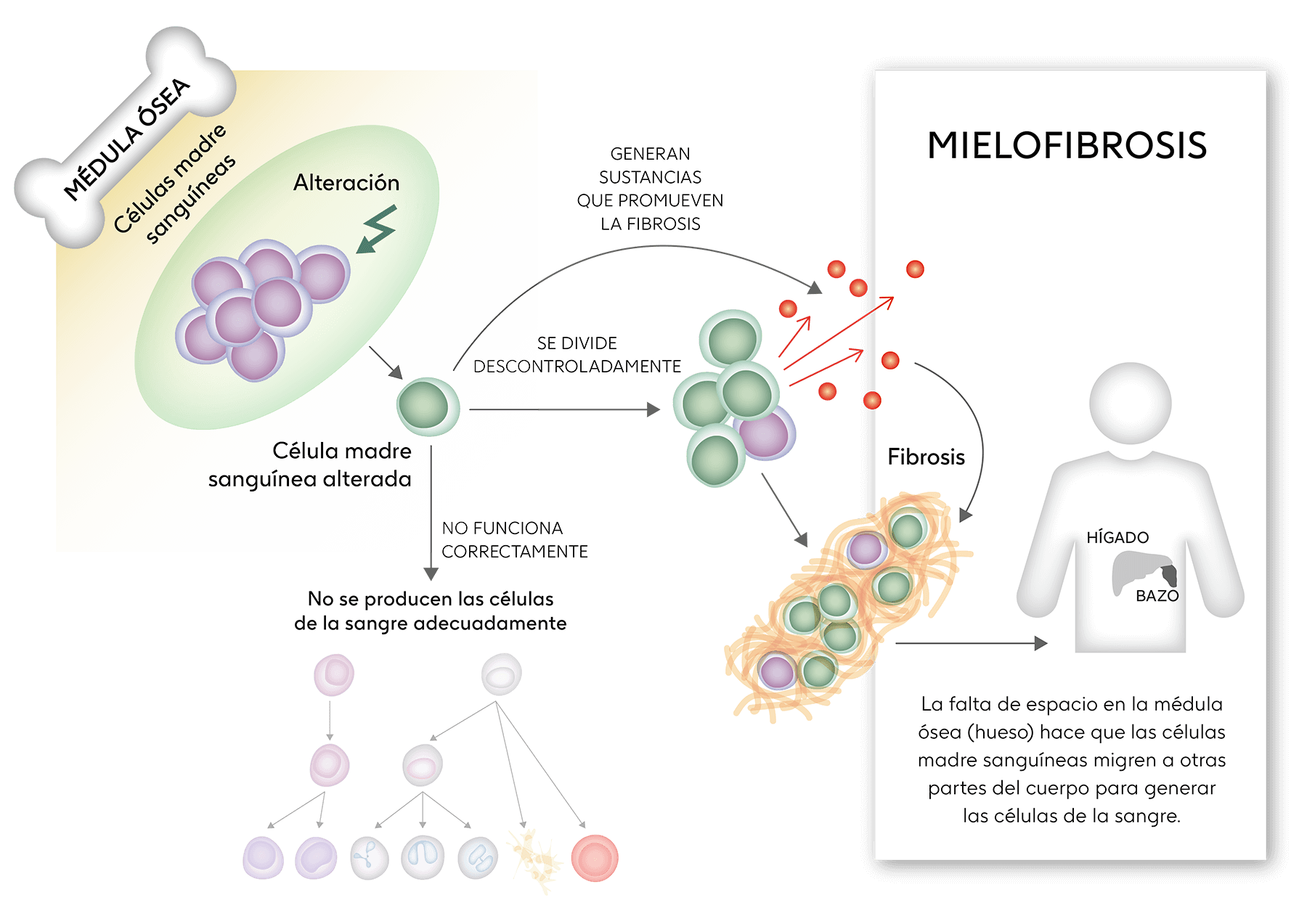 mielofibrosis que es