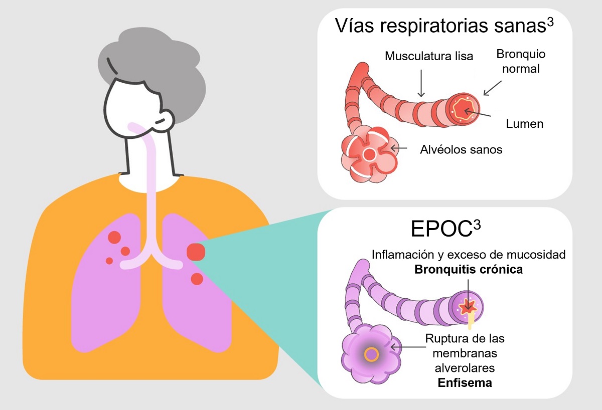 Ilustración de las vías respiratorias sanas versus con EPOC