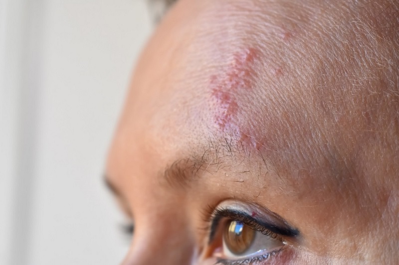 Effects of Herpes Zoster shown on a forehead of a young woman