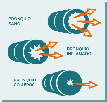 bronquios de un paciente de epoc Bronquios bronquios de un paciente de epoc